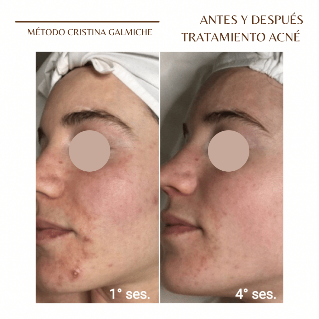 Antes y después Acné 4 Cristina Galmiche