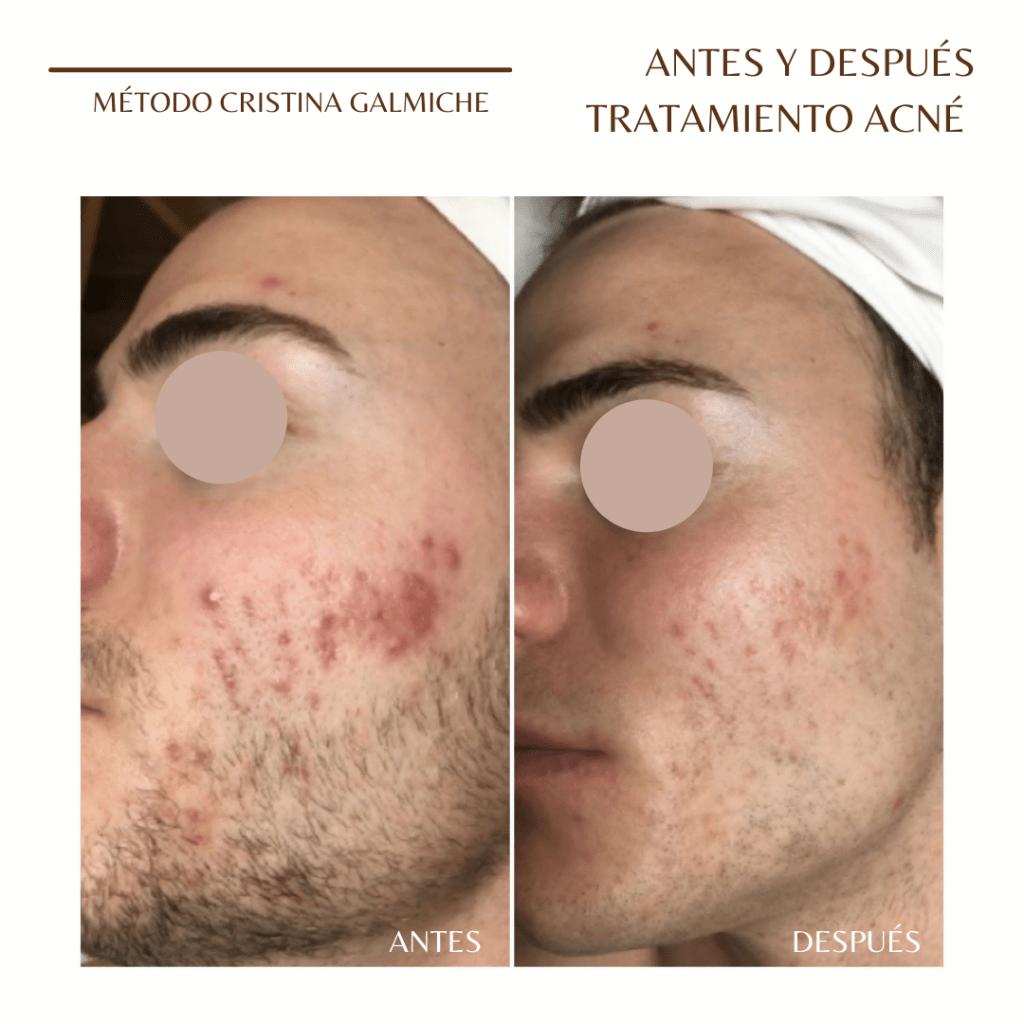 Antes y después Acné Cristina Galmiche