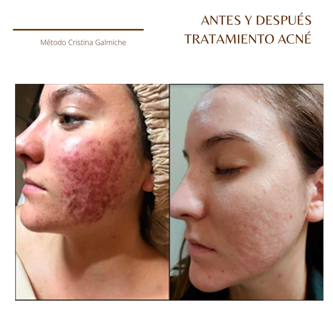 Antes-y-después-Acné1-Cristina-Galmiche