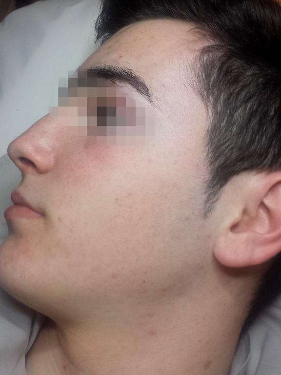 tratamiento acne adulto