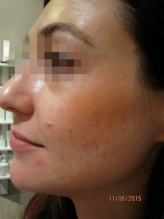 tratamiento acne
