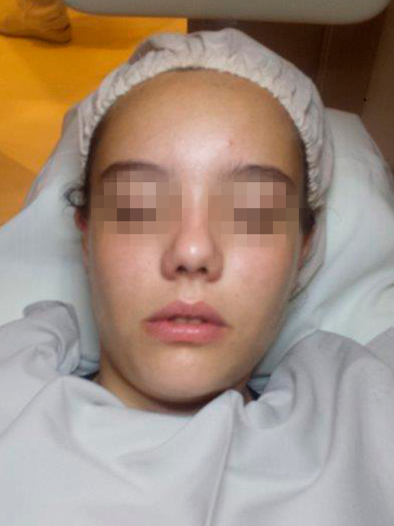 tratamiento efectivo contra el acne