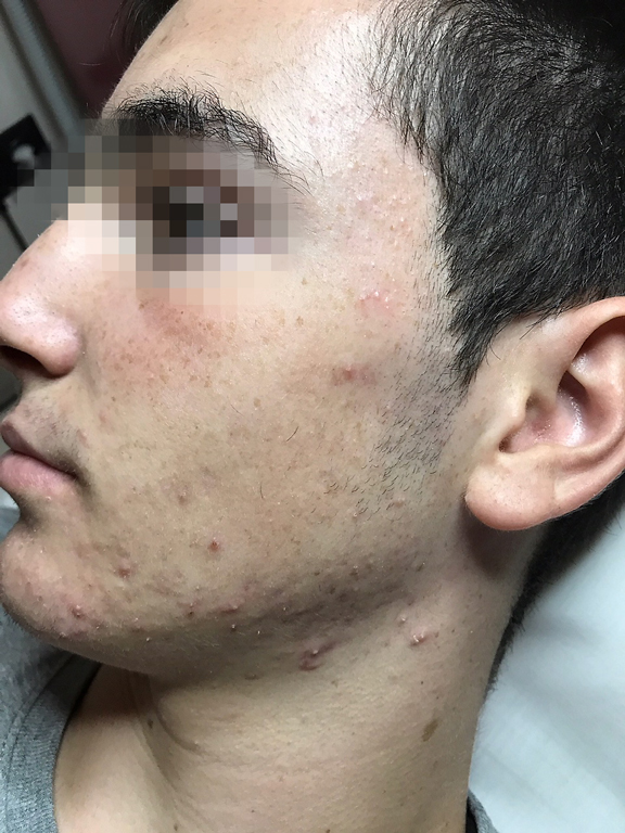 tratamiento eficaz para el acne