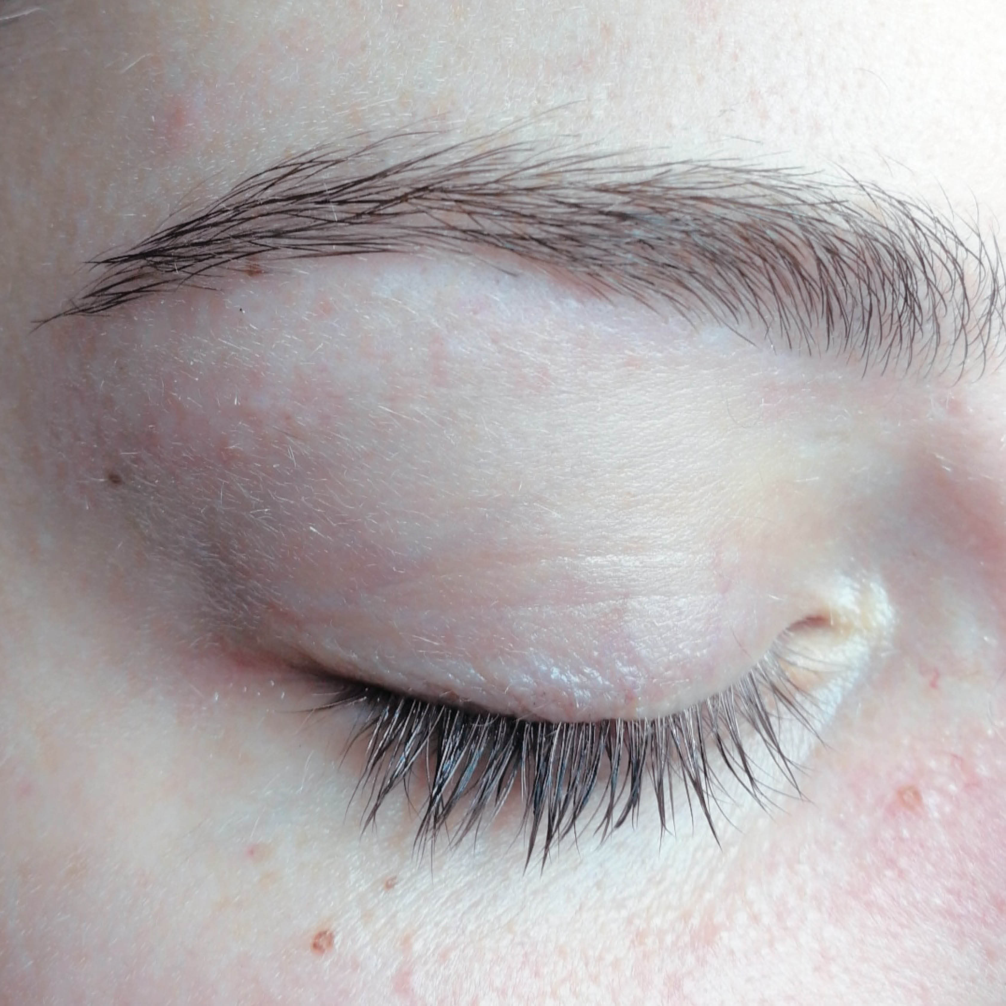 oxigenacion contra la rosacea